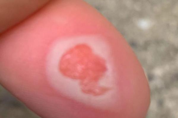 LEPAK JOJ JE SPRŽIO KOŽU NA PRSTU, A ONDA ŠOK: Pojavio se lik najpoznatije osobe na svetu! (FOTO)