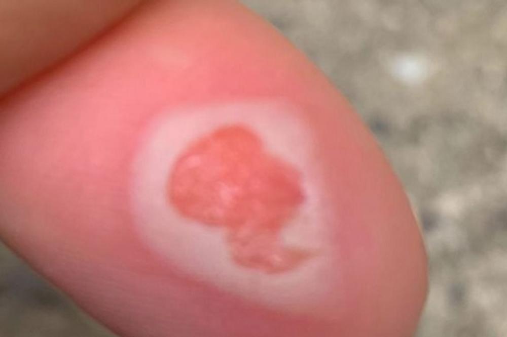 LEPAK JOJ JE SPRŽIO KOŽU NA PRSTU, A ONDA ŠOK: Pojavio se lik najpoznatije osobe na svetu! (FOTO)