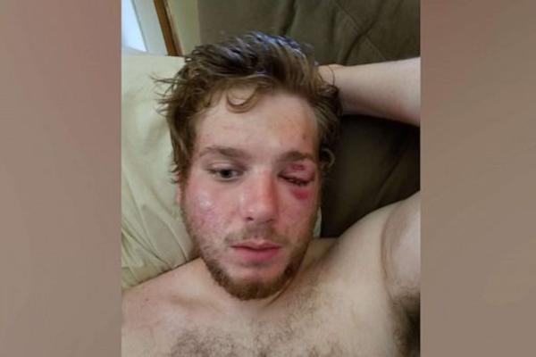 OVAJ AMERIKANAC JE OSTAO BEZ OKA kad su ga napali policajci u Denveru! (FOTO)