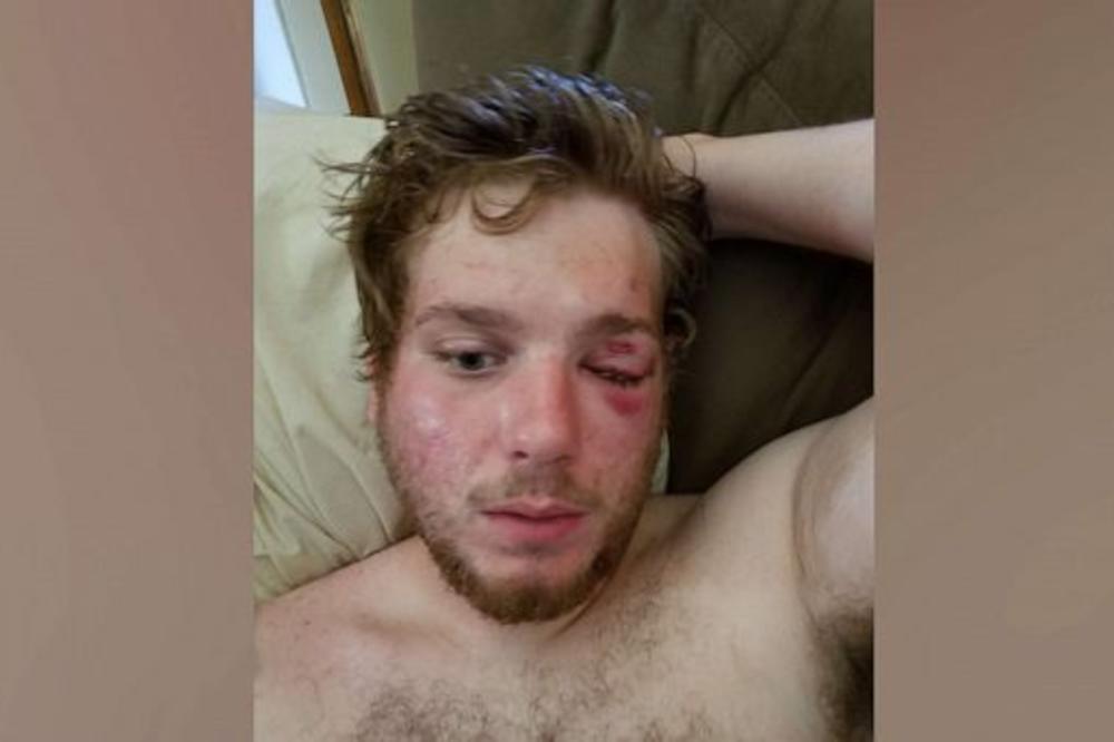 OVAJ AMERIKANAC JE OSTAO BEZ OKA kad su ga napali policajci u Denveru! (FOTO)