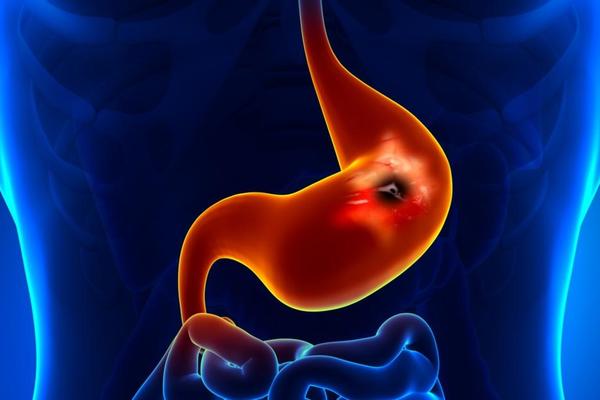 POZNATI TRAVAR OTKRIO: Evo kako da izlečite čir na potpuno prirodan načun