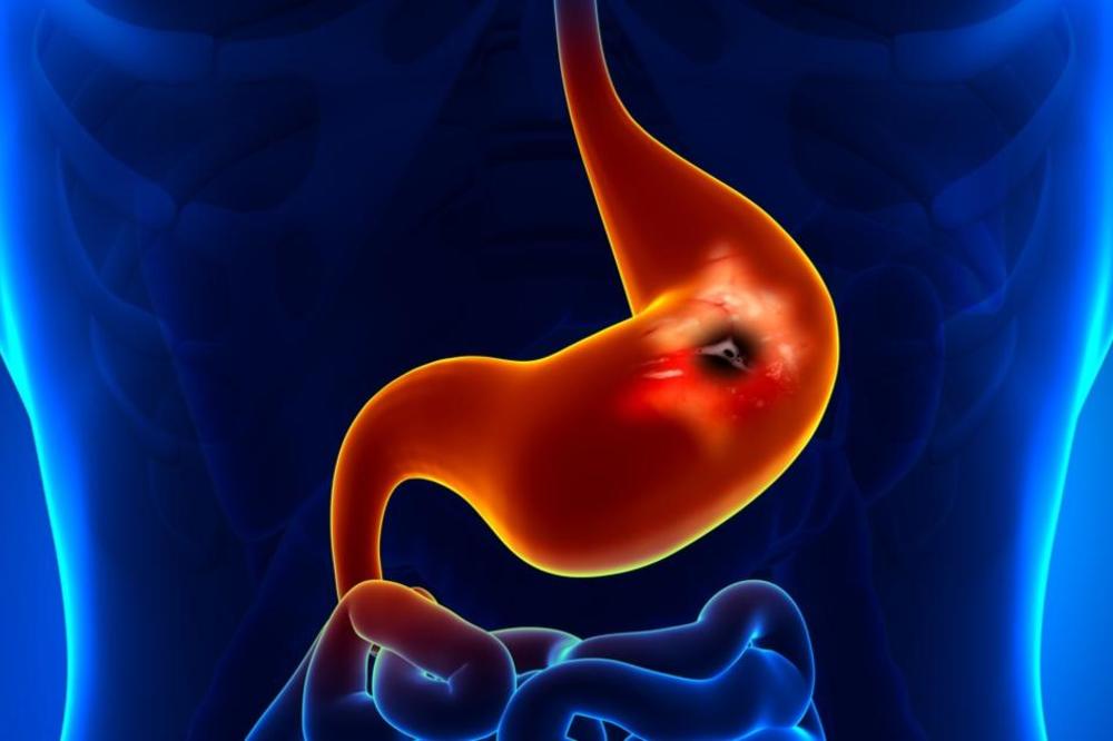 POZNATI TRAVAR OTKRIO: Evo kako da izlečite čir na potpuno prirodan načun