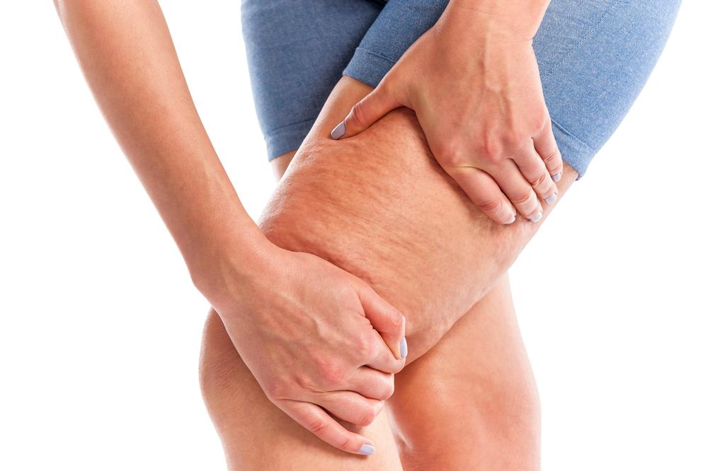 EVO KAKO SAMI DA SE REŠITE CELULITA: Uštedećete i NOVAC!