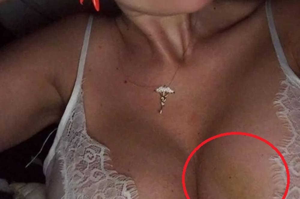 NAŠA PEVAČICA POKAZALA MODRICU, CEO LEVI SILIKON POZELENEO OD UDARCA! A samo što je jedva preživela operaciju