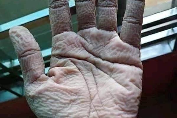 OVAKO IZGLEDA RUKA DOKTORA POSLE 10 SATI NOŠENJA RUKAVICA: Pogledajte kroz šta oni svakog dana prolaze (FOTO)