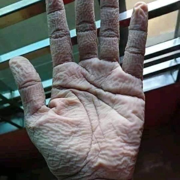 OVAKO IZGLEDA RUKA DOKTORA POSLE 10 SATI NOŠENJA RUKAVICA: Pogledajte kroz šta oni svakog dana prolaze (FOTO)