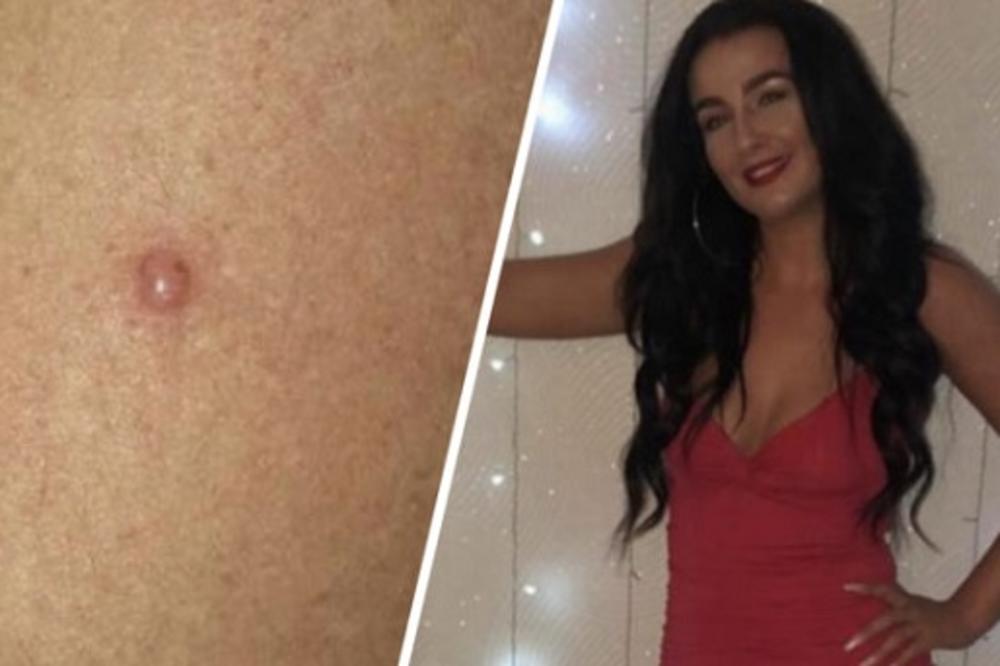 5 puta nedeljno išla u solarijum, pa primetila PLIK: Doktor odmahnuo rukom, a onda joj se otvorio PAKAO