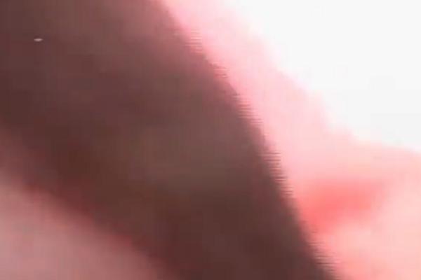 ŽENI IZ NOSA IZVAĐENA KRVOPIJA OD 15 CM: Grozomoran snimak, ništa gadnije danas nećete videti! (VIDEO)