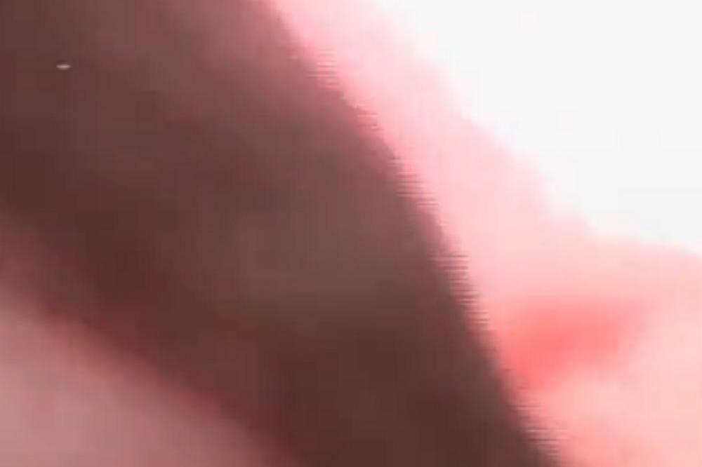 ŽENI IZ NOSA IZVAĐENA KRVOPIJA OD 15 CM: Grozomoran snimak, ništa gadnije danas nećete videti! (VIDEO)