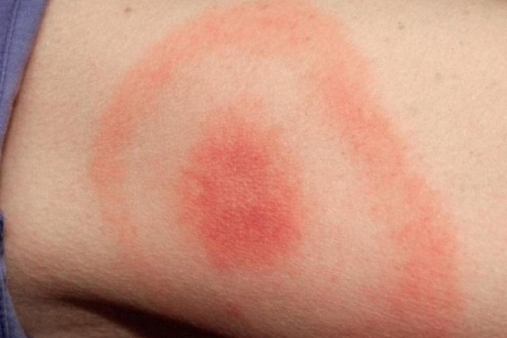 OPREZ! AKO PRIMETITE OVU CRVENU FLEKU NA TELU ODMAH MORATE KOD LEKARA: Mnogi je ignorišu, a onda bude kasno!
