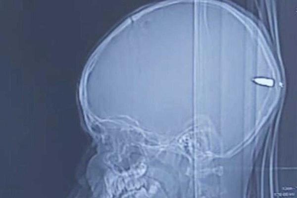 RODITELJI SU DOVELI U BOLNICU DEČAKA (9) JER MU SE MNOGO SPAVALO: Kad su mu snimili GLAVU ostali su u ŠOKU!