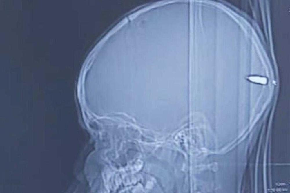 RODITELJI SU DOVELI U BOLNICU DEČAKA (9) JER MU SE MNOGO SPAVALO: Kad su mu snimili GLAVU ostali su u ŠOKU!