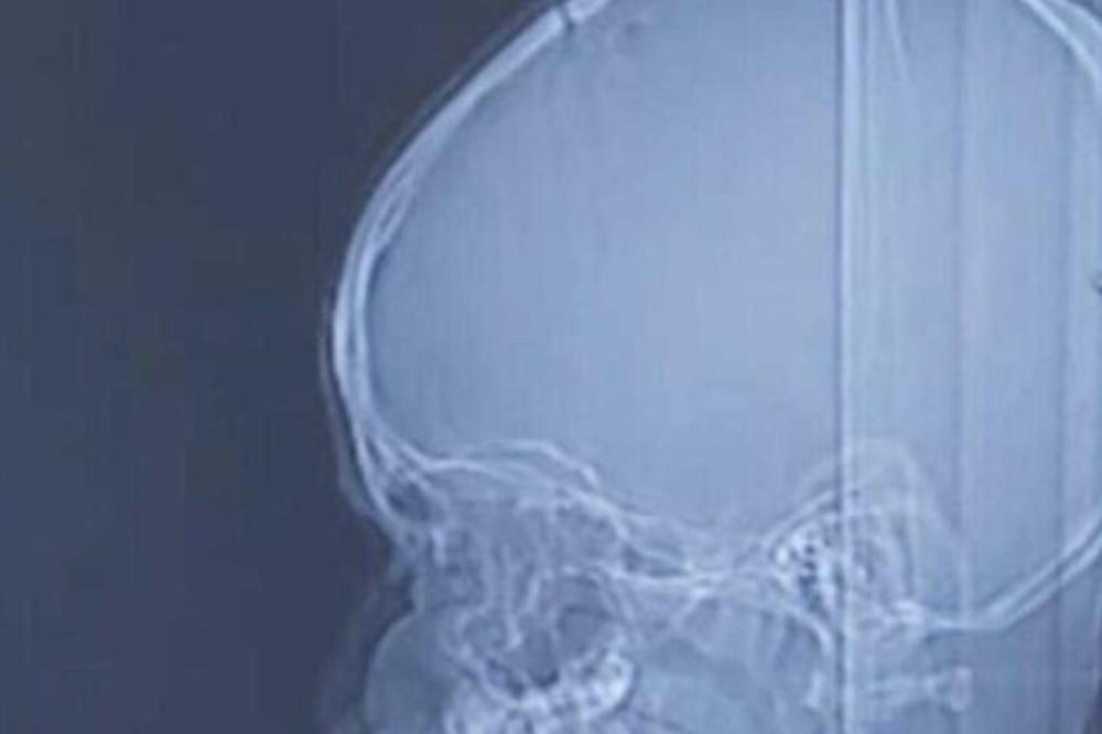 Imao je glavobolje i drhtavicu, kad su mu lekari snimili glavu, sledili su se: Ovo je gmizalo unutra, fuj!