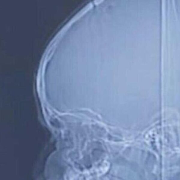 Imao je glavobolje i drhtavicu, kad su mu lekari snimili glavu, sledili su se: Ovo je gmizalo unutra, fuj!