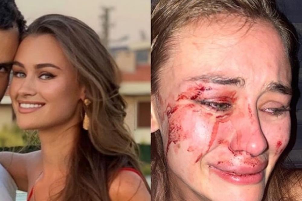 POZNATA MANEKENKA UNAKAŽENA U TURSKOJ: Brutalno su se IŽIVLJAVALI nad NJOM, a POSLEDICE su JEZIVE! (FOTO)