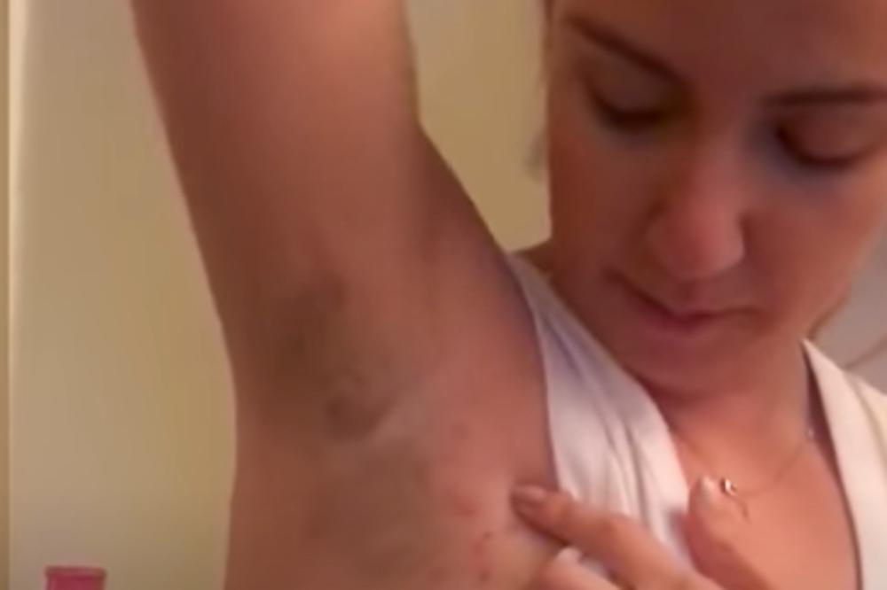 POJAVILO JOJ SE CRNO ISPOD PAZUHA: Samo je namazala ovu JEDNU STVAR i sve je postalo drugačije!