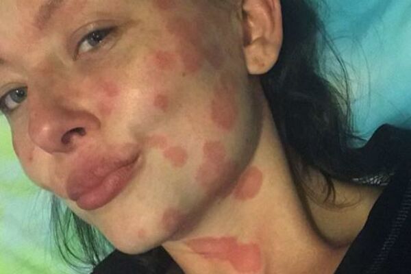 GOVORILI SU JOJ DA IZGLEDA KAO DA JE KUGA ALI SU LEKARI POGREŠILI! Dobila je fleke, a onda su se šokirali