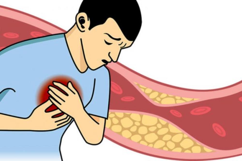 DR BIJEKIĆ MACUT UPOZORAVA NA PRVE SIMPTOME POVIŠENOG HOLESTEROLA! Problem se uglavnom otkrije slučajno!