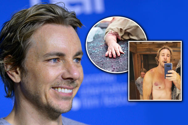 ČUVENI AMERIČKI GLUMAC DOŽIVEO TEŠKU NESREĆU! Pogledajte šta mu se dogodilo