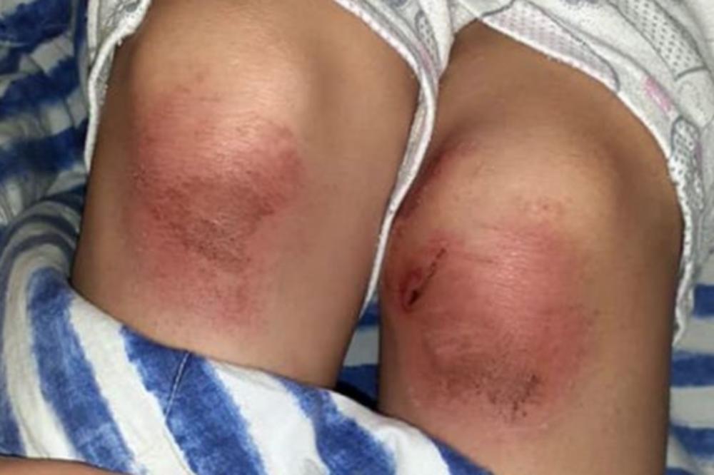 UZNEMIRUJUĆE! Devojčicu iz Požege napao pitbul na školskom terenu: VUKAO JU JE PO ASFALTU I UJEDAO!