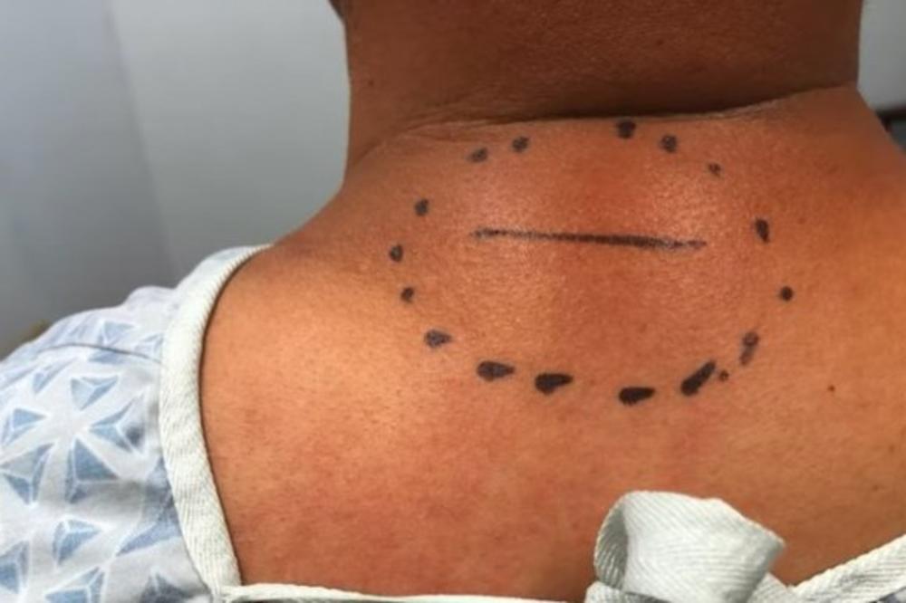 IMALA JE OVAKVU KVRGU NA LEĐIMA! Oprez ako napipate OVO! U PITANJU JE VRSTA TUMORA! (VIDEO)