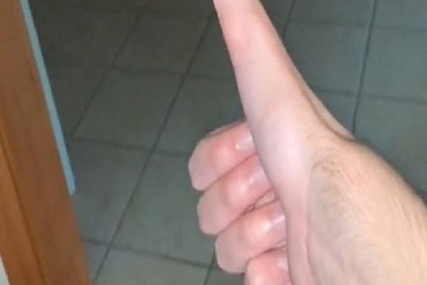 DOKTORI OSTALI U ČUDU! Momak sve zaprepastio dužinom palca: Samo je rastao i rastao, a tek šta sve s njim radi...