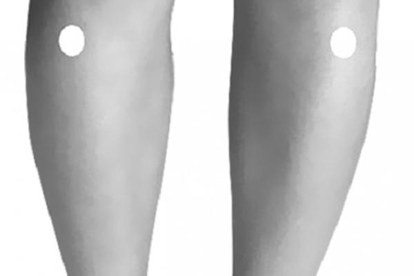 OVAJ OPASAN ZNAK VISOKOG HOLESTEROLA "UDARA" U NOGE: Kada čujete o čemu se radi, ZANEMEĆETE