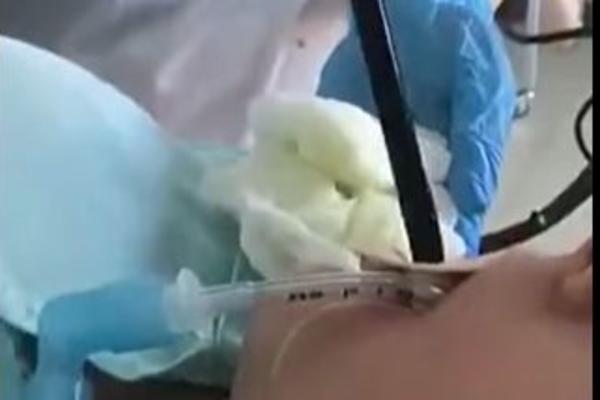 ZMIJA ŽENI UPUZALA U USTA DOK JE SPAVALA I UŠLA U JEDNJAK: Ovo je snimak lekara koji joj VADE GMIZAVCA! (VIDEO)