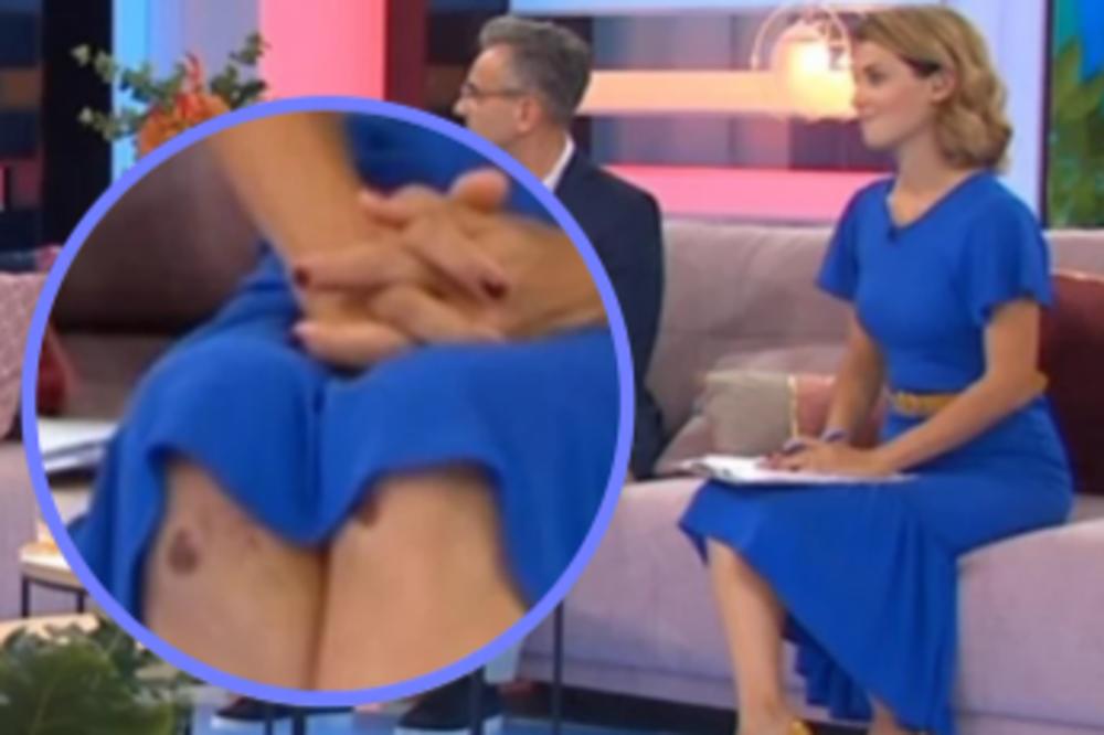 VODITELJKA JUTARNJEG PROGRAMA POKAZALA KOLENA PUNA MODRICA: Sad je otkriveno i KAKO IH JE ZARADILA!