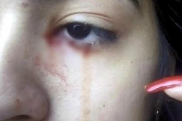 ONA SVAKOG DANA PLAČE KRV, DOKTORI U ŠOKU KADA SU VIDELI: Nema bolove, a onda su otkrili jeziv uzrok svemu! (FOTO)