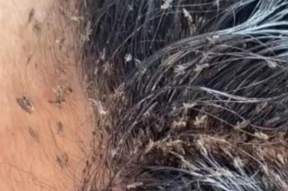 ZAMISLITE 15.000 VAŠAKA NA GLAVI! Od snimka jezivog prizora počeće da vas svrbi glava, GLEDAJTE NA SVOJU RUKU