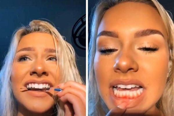 JESTE LI NORMALNI, PRESTANITE OVO DA RADITE! Tik-Tokom kruži BIZARAN TREND, stomatolozi su ZGROŽENI (VIDEO)