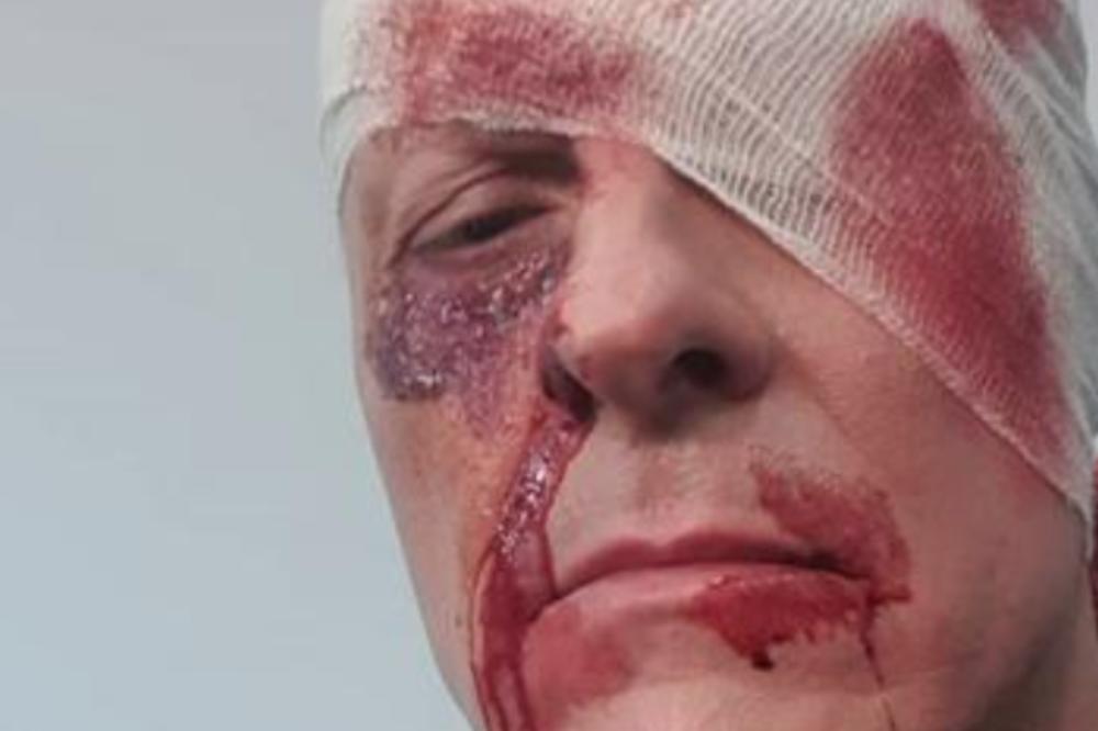 UNAKAŽENO LICE, KRVAV I MODAR: Đorđe David isprebijen u zavojima, evo šta se dogodilo pevaču! (FOTO)