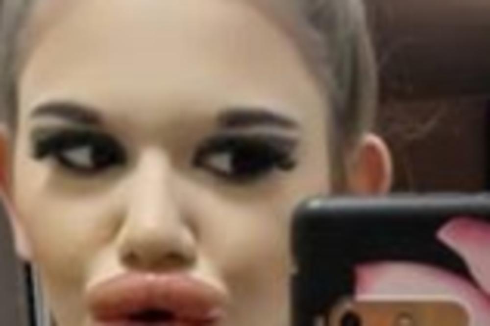 OVA DEVOJKA IMA NAJGROZNIJE USNE NA SVETU, LIČE NA MAJMUNSKU G*ZICU! To nije jedino NAKARADNO, izgleda OVAKO