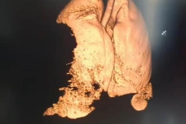 OVO SU PLUĆA PACIJENTA OD 27 GODINA POJEDENA KORONOM: Srpski pulmolog objavio ZASTRAŠUJUĆI SNIMAK! (VIDEO)
