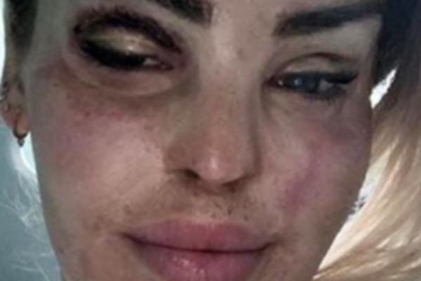 VODITELJKA ČEKA 400. OPERACIJU, OBJAVILA SLIKU POSLE 399 ZAHVATA NA LICU: Slike su užasavajuće, POSTALA STRAŠILO!