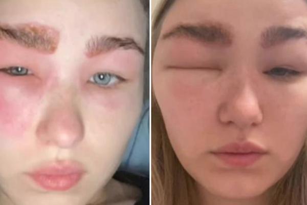 OVA DEVOJKA SE UNAKAZILA BJUTI TRETMANOM! Ovo više nikada neće uraditi (FOTO)