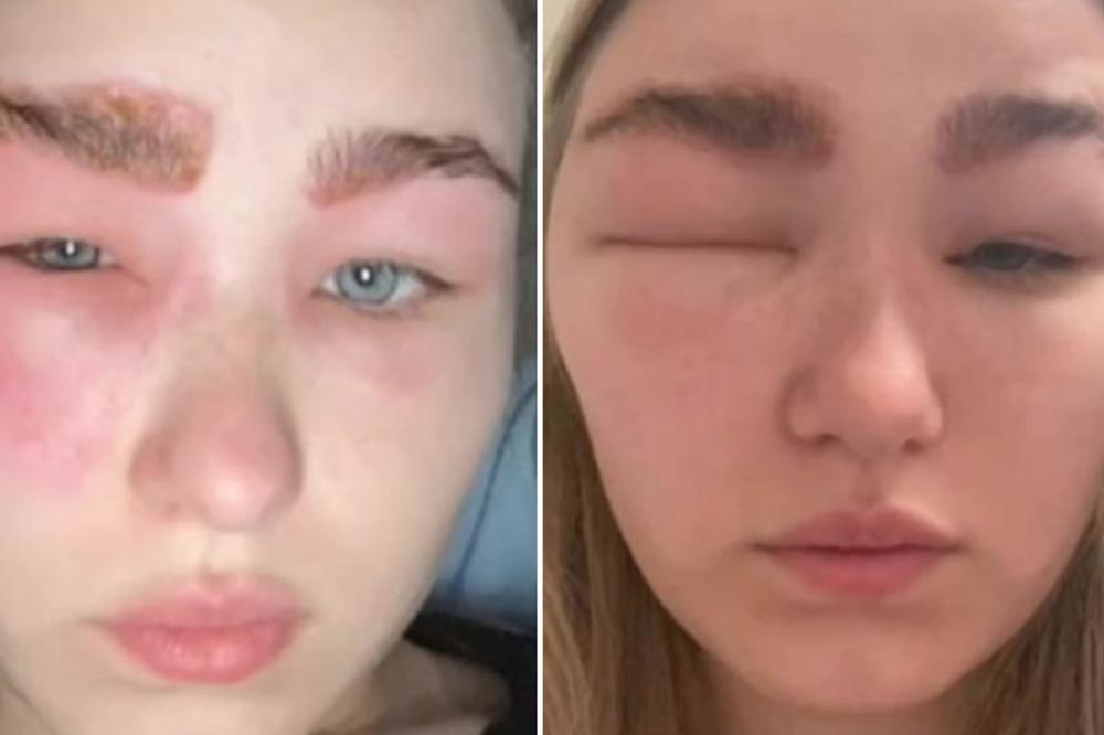 OVA DEVOJKA SE UNAKAZILA BJUTI TRETMANOM! Ovo više nikada neće uraditi (FOTO)