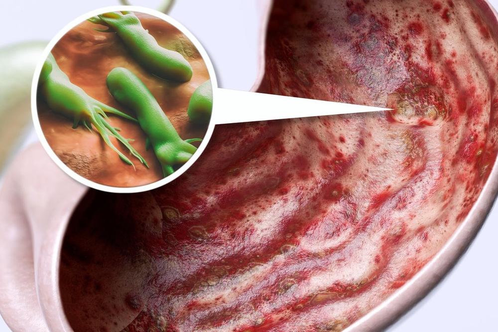 BOLOVI, MUČNINA, ANKSIOZNOST, UMOR, DEPRESIJA: 1 BAKTERIJA može biti uzrok svega!