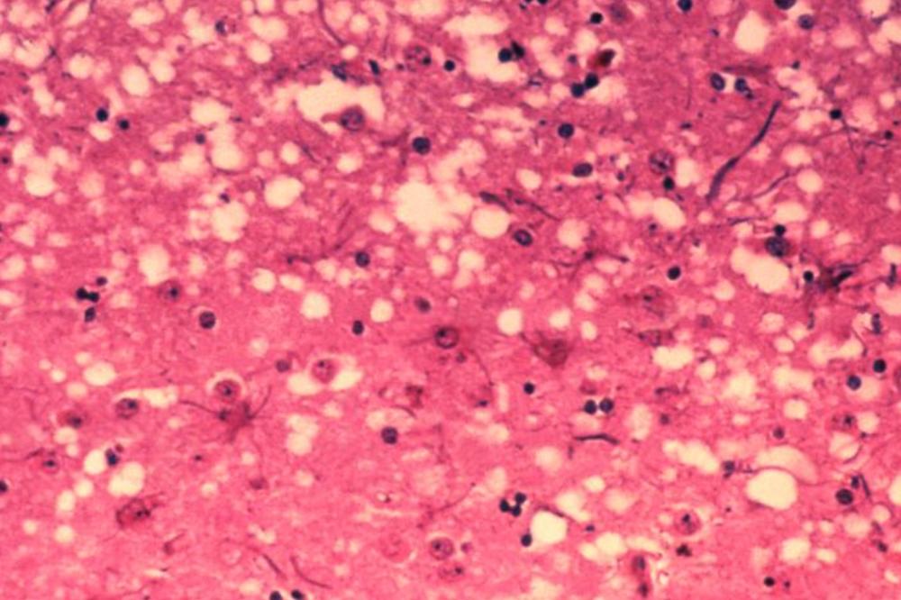 BOLEST KOJA UNIŠTAVA MOZAK POSTAJE SVE ČEŠĆA, naučnici upozoravaju će biti BRUTALNO