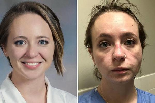 OVO JE LICE MEDICINSKE SESTRA PRE I POSLE 8 MESECI BORBE SA KORONOM! Ljudi, NOSITE MASKE!