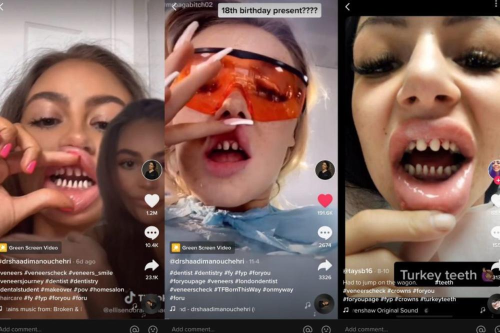 INFLUENSERI STRUŽU ZUBE DA BI IM ZUBARI NAPRAVILI NOVE, SAVRŠENE: Zbog ovoga će do 40. godine svi da nose PROTEZE!