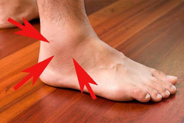 KADA VAM OTIČU ČLANCI: Stavite OVO na nogu svaki dan i smanjite otoke i bolove!