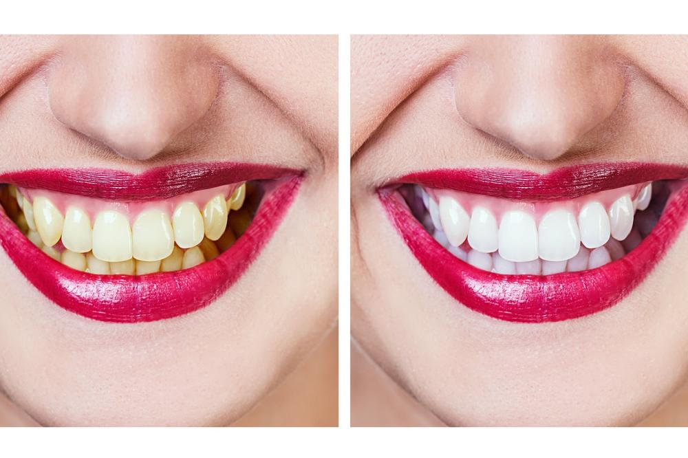 ZAPOČNITE DAN SA OSMEHOM: U rekordnom roku izbelićete zube na ovaj potpuno bezbedan način!