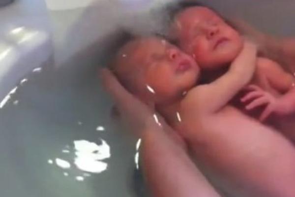 Ovo su blizanci koji su zapanjili svet nakon rođenja: OVO JE SVIMA NEVEROVATNO! (VIDEO)