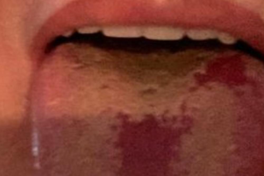 DOKTOR OBJAVIO FOTOGRAFIJU "KOVID JEZIKA", CEO JE U ČIREVIMA: Sve više ljudi nam se javlja sa ovim simptomom (FOTO)