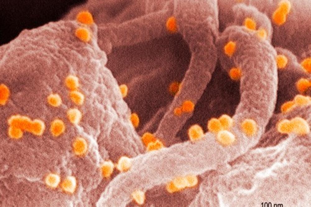 NEVEROVATNO OTKRIĆE O SIDI: Prvi čovek se zarazio još pre 100 godina, tvrdi kanadski naučnik