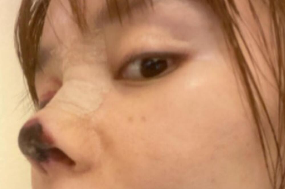 JEZIVO: Glumici nakon loše odrađene estetske operacije OTPAO DEO NOSA (FOTO)