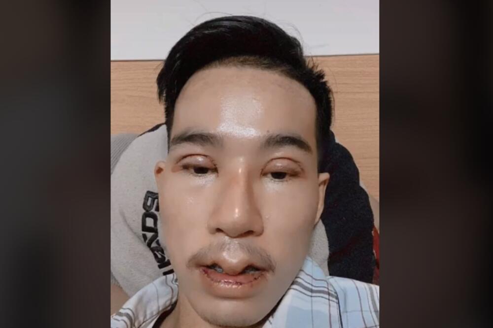 VIJETNAMAC POTROŠIO 17.000 DOLARA NA PLASTIČNE OPERACIJE: Razlog za to će vas ŠOKIRATI (VIDEO)