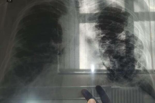 OVE RUPE NISU NASTALE OD METAKA: Dr Ivana objavila JEZIVI snimak pluća momka koji je oboleo od KORONE (FOTO)